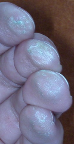 My finger tips today